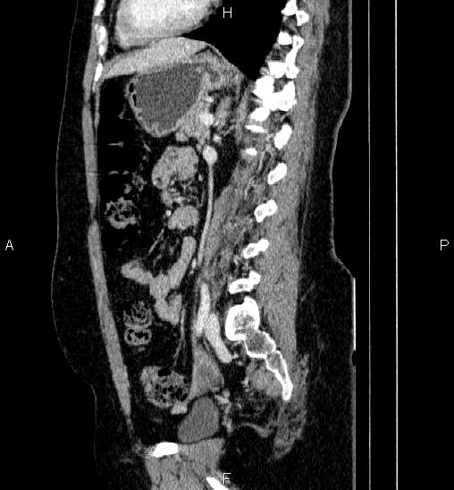 Adrenal cortical carcinoma (Radiopaedia 84882-100379 Sagittal C+ portal venous phase 55).jpg