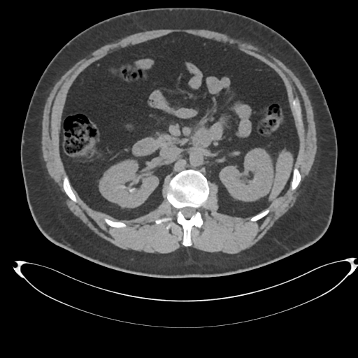 File:Adrenal cyst (Radiopaedia 45625-49778 Axial non-contrast 45).png