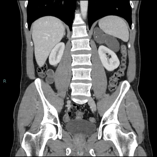 Adrenal cystic lymphangioma (Radiopaedia 83161-97534 Coronal C+ portal venous phase 47).jpg