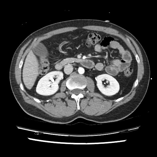 Adrenal gland trauma (Radiopaedia 81351-95078 Axial Dual bolus trauma C+ 73).jpg