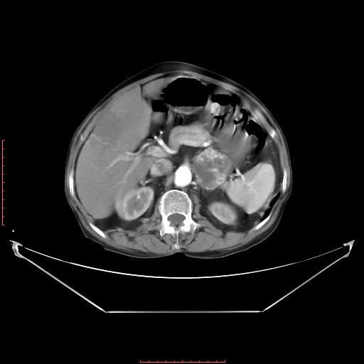 Adrenal hemangioma (Radiopaedia 68923-78668 Axial C+ arterial phase 29).jpg