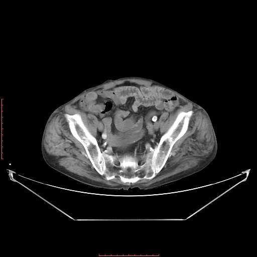 Adrenal hemangioma (Radiopaedia 68923-78668 Axial C+ portal venous phase 58).jpg