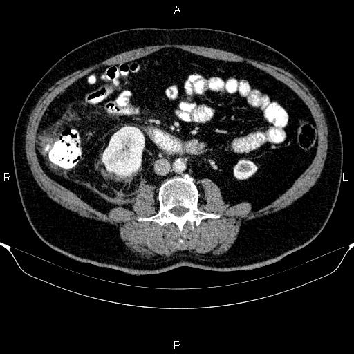 Adrenal hemorrhage (Radiopaedia 62622-70916 Axial C+ portal venous phase 103).jpg
