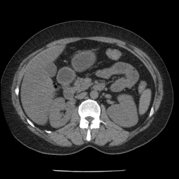 Adrenal myelolipoma (Radiopaedia 43401-46759 Axial non-contrast 34).jpg