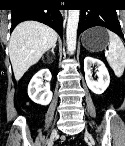 Adrenal myelolipoma (Radiopaedia 82742-96986 Coronal renal cortical phase 49).jpg