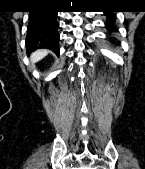 Adrenal myelolipoma (Radiopaedia 82742-96986 Coronal renal cortical phase 66).jpg