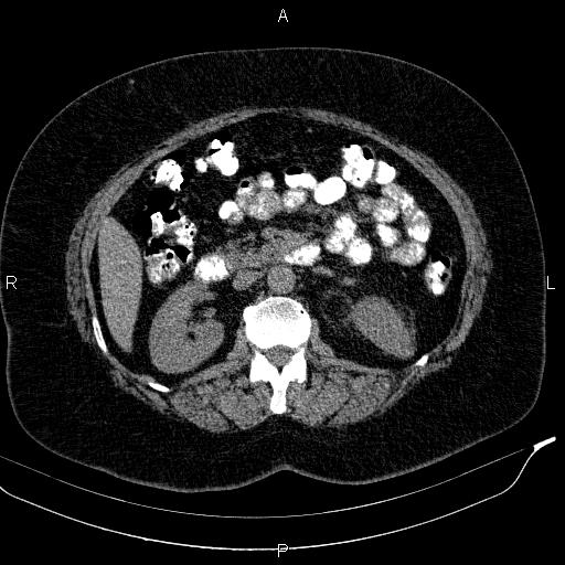 Adrenal myelolipoma (Radiopaedia 84319-99617 Axial With oral contrast 93).jpg