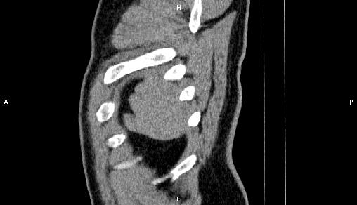 Adrenal myelolipoma (Radiopaedia 84321-99619 Sagittal non-contrast 104).jpg