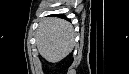 Adrenal myelolipoma (Radiopaedia 84321-99619 Sagittal non-contrast 12).jpg