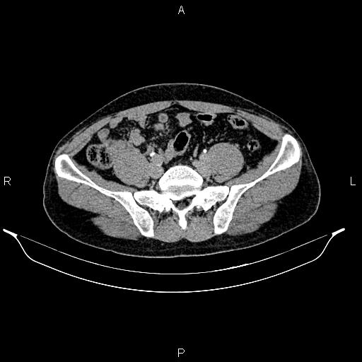 Adrenal myelolipoma (Radiopaedia 87794-104246 Axial renal excretory phase 74).jpg