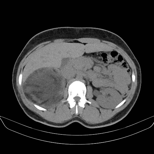 Adrenal myelolipoma - bilateral (Radiopaedia 74805-85810 Axial non-contrast 28).jpg