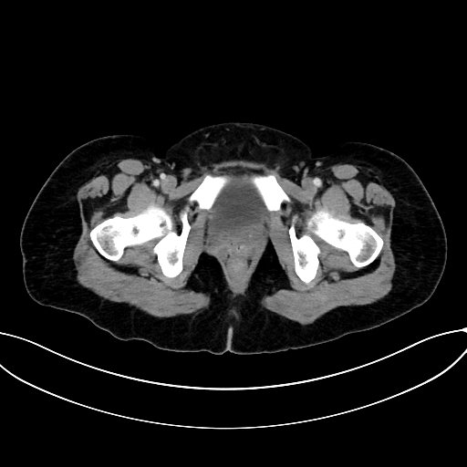 Adrenocortical carcinoma (Radiopaedia 87281-103569 Axial C+ portal venous phase 87).jpg