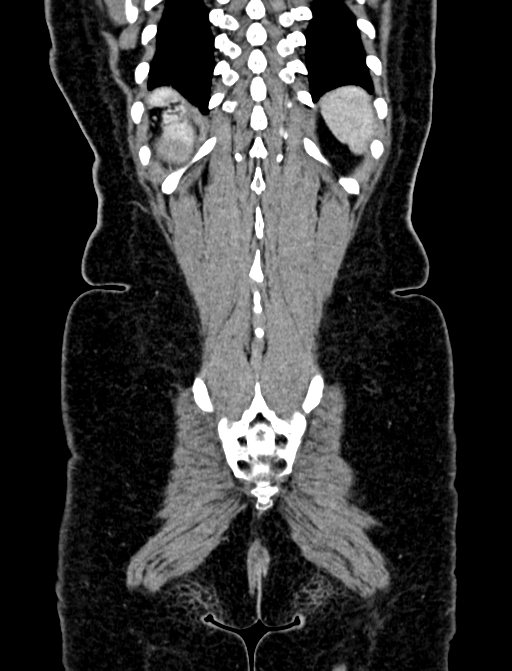 Adrenocortical carcinoma (Radiopaedia 87281-103569 Coronal C+ portal venous phase 138).jpg