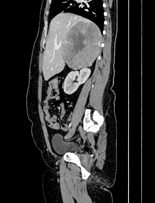 Adrenocortical carcinoma (Radiopaedia 87281-103569 Sagittal C+ portal venous phase 95).jpg