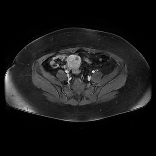 File:Adult granulosa cell tumor of the ovary (Radiopaedia 64991-73953 axial-T1 Fat sat post-contrast dynamic 75).jpg