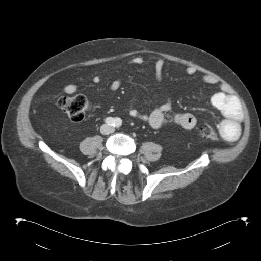 Adult ileal intussusception with secondary obstruction (Radiopaedia 30395-31051 Axial C+ portal venous phase 48).jpg
