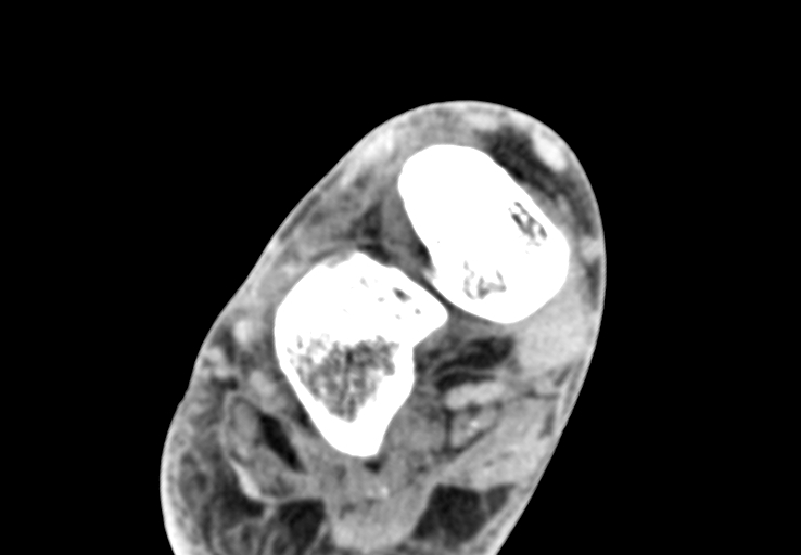 Advanced osteomyelitis due to open metatarsal fracture (Radiopaedia 83891-99095 Axial non-contrast 14).jpg