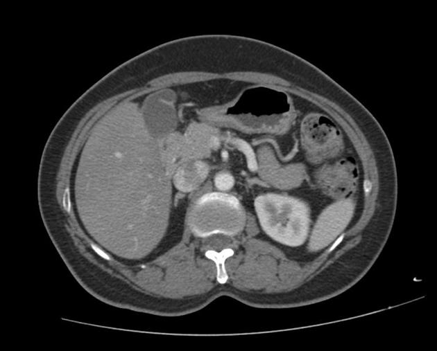 File:Agenesis of the dorsal pancreas (Radiopaedia 11180-11545 Axial 2).jpg
