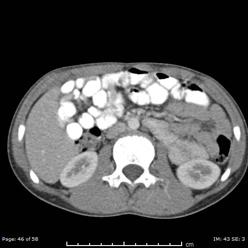 File:Agenesis of the gallbladder (Radiopaedia 55454-61905 Axial 32).jpg