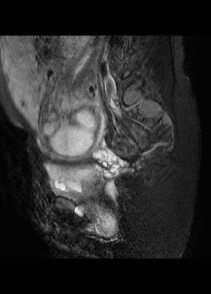 File:Aggressive angiomyxoma of the pelvis and perineum (Radiopaedia 59162-66479 Sagittal T2 fat sat 8).jpg