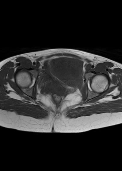 File:Aggressive angiomyxoma of the pelvis and perineum (Radiopaedia 59162-66479 T1 11).jpg