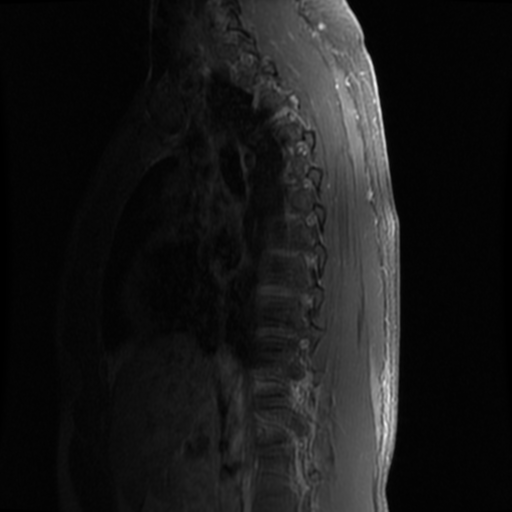 File:Aggressive vertebral hemangioma (Radiopaedia 39937-42404 B 16).png