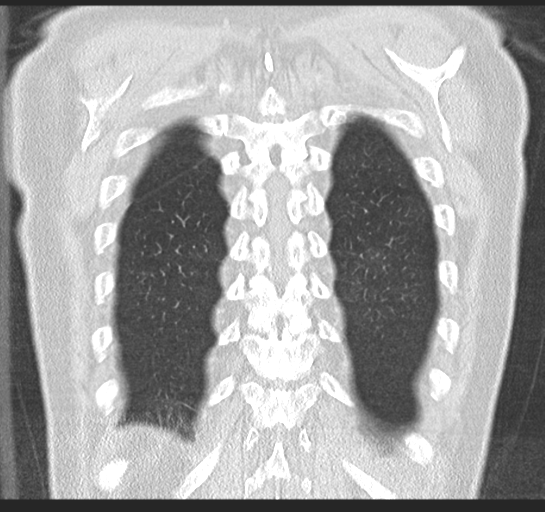 Allergic bronchopulmonary aspergillosis (Radiopaedia 44760-48571 Coronal lung window 50).png