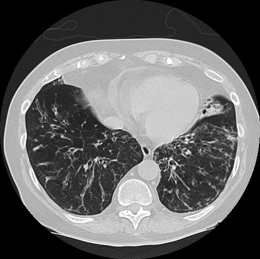 Alpha-1-antitrypsin deficiency (Radiopaedia 72058-82557 Axial lung window 53).jpg