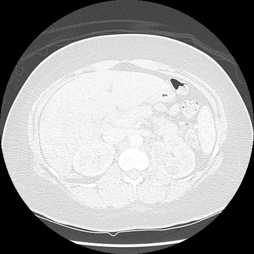 Alveolar soft part sarcoma - right leg (Radiopaedia 59432-67091 Axial lung window 119).jpg