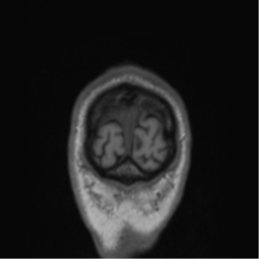 File:Alzheimer's disease- with Gerstmann syndrome and dressing apraxia (Radiopaedia 54882-61150 Coronal T1 3).png