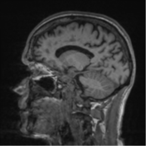 File:Alzheimer's disease- with apraxia (Radiopaedia 54763-61011 Sagittal T1 28).png