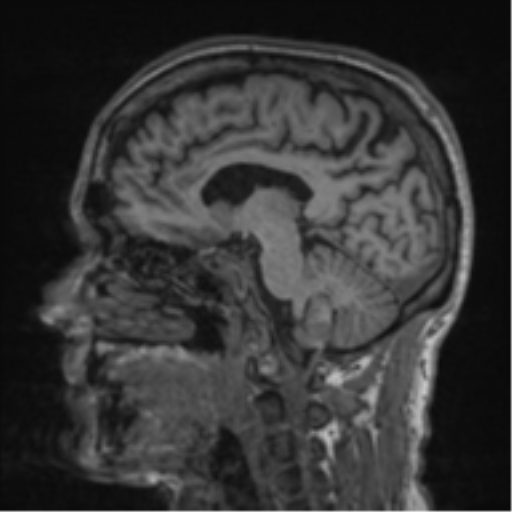 File:Alzheimer's disease- with apraxia (Radiopaedia 54763-61011 Sagittal T1 40).png