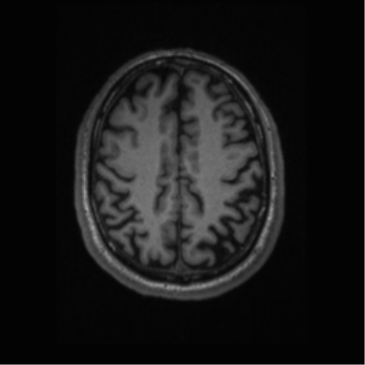 File:Alzheimer disease - probable (Radiopaedia 35334-36837 Axial T1 54).png