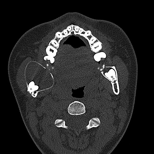 File:Ameloblastoma (Radiopaedia 26645-26793 E 57).jpg