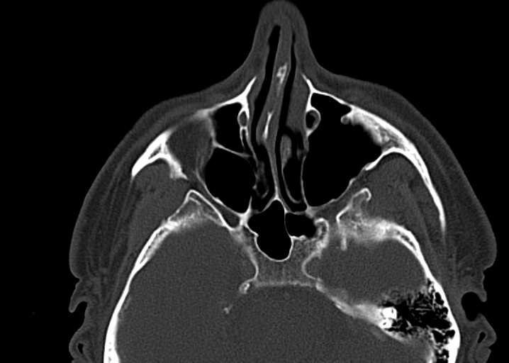 Ameloblastoma (Radiopaedia 38520-40623 D 10).png