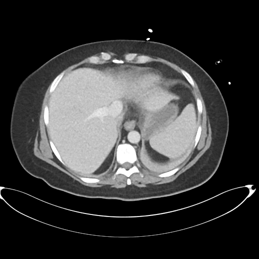 File:Amoebic liver abscess (Radiopaedia 52611-58530 A 15).png