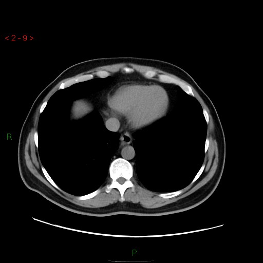 File:Ampullary carcinoma (Radiopaedia 56396-63056 Axial non-contrast 6).jpg