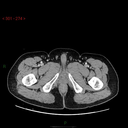 Ampullary carcinoma (Radiopaedia 56396-63056 C 110).jpg