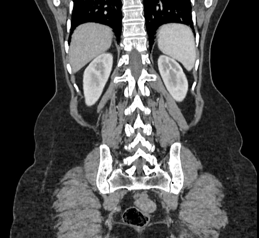 File:Ampullary tumor (Radiopaedia 60333-67998 B 63).jpg