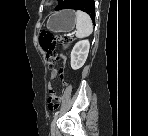 File:Ampullary tumor (Radiopaedia 60333-67998 C 48).jpg
