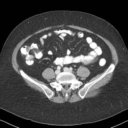 Anal adenocarcinoma - tumor regression grade 1 (Radiopaedia 31358-32103 Axial POST 48).jpg