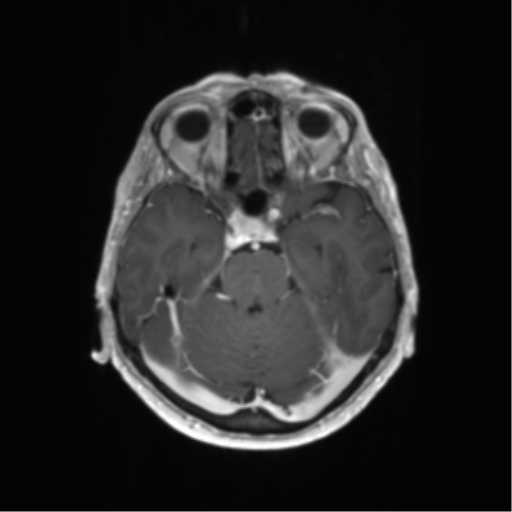 File:Anaplastic astrocytoma (Radiopaedia 86943-103160 Axial T1 C+ 5).png