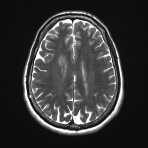 File:Anaplastic astrocytoma - thalamic glioma (Radiopaedia 59709-67115 Axial T2 25).png
