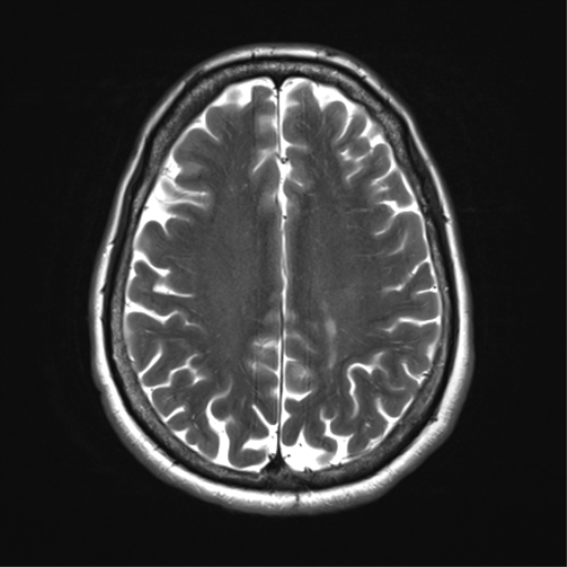 File:Anaplastic astrocytoma - thalamic glioma (Radiopaedia 59709-67115 Axial T2 26).png