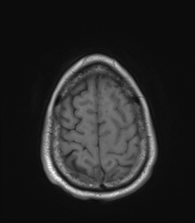 Anaplastic astrocytoma IDH wild-type (Radiopaedia 49984-55273 Axial T1 49).png
