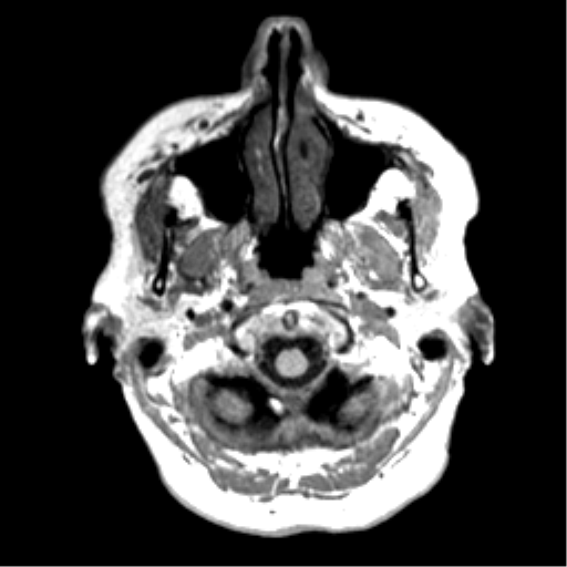 Anaplastic astrocytoma IDH wild-type (pseudoprogression) (Radiopaedia 42209-45277 Axial T1 6).png