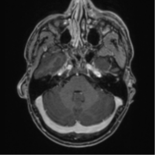 Anaplastic oligodendroglioma with skull fracture (Radiopaedia 74831-85845 Axial T1 C+ fat sat 12).png