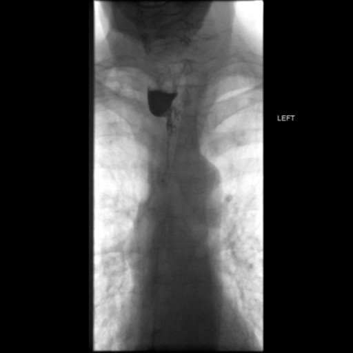 File:Anastomotic stricture post Ivor Lewis esophagectomy (Radiopaedia 47937-52715 Frontal 18).png