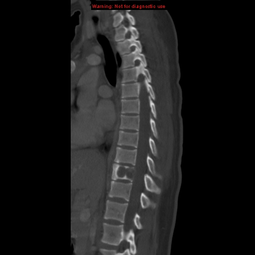 File:Aneurysmal bone cyst (Radiopaedia 9419-10102 Sagittal bone window 6).jpg
