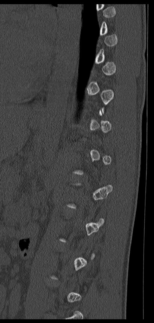 Aneurysmal bone cyst T11 (Radiopaedia 29294-29721 Sagittal bone window 24).jpg